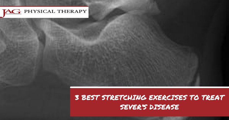 3 Best Stretching Exercises to Treat Sever’s Disease
