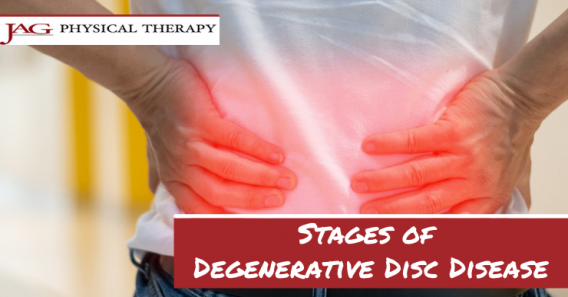 Stages of Degenerative Disc Disease