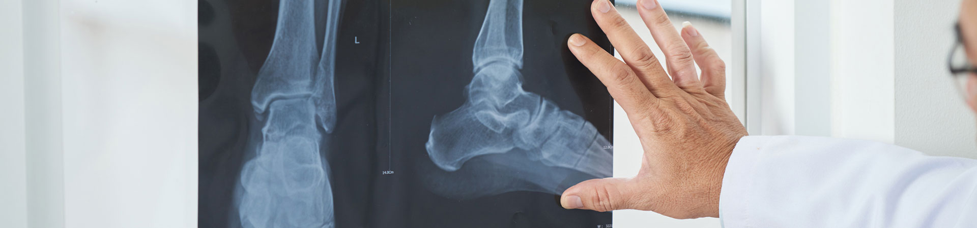 Foot and Ankle Fractures