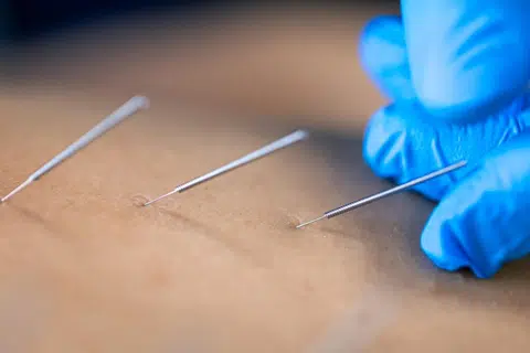 Dry Needling in Pelvic Health